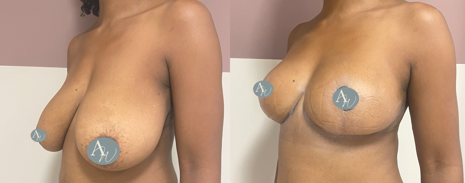 Avant/Après lifting seins et réduction mammaire